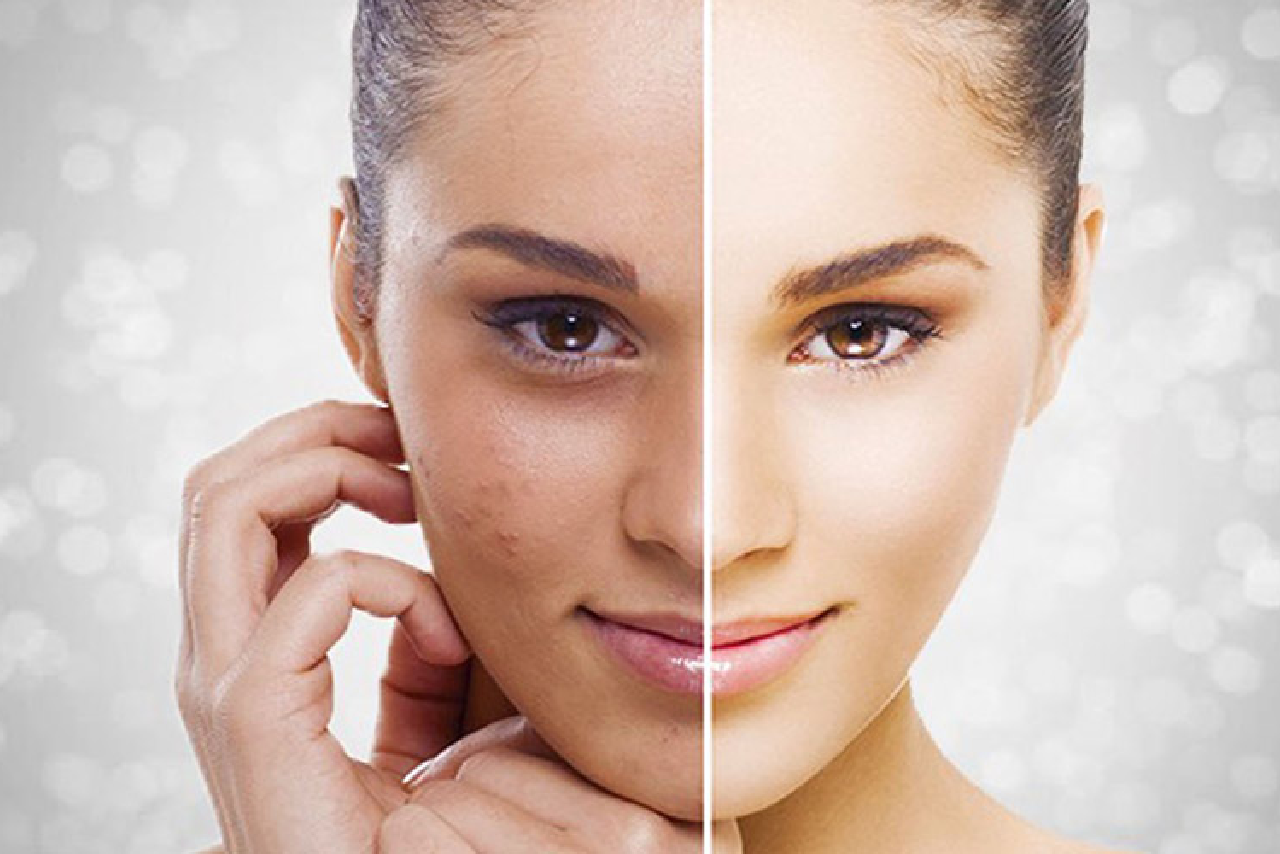 Advanced Acne and Pigmentation Treatments for Clear Skin
